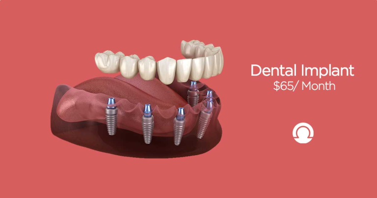 Are Full Mouth Dental Implants the Best Solution for Permanent Tooth Loss?